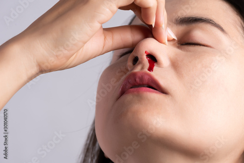 Nosebleed , a young woman with a bloody nose. Healthcare and medical concept. photo