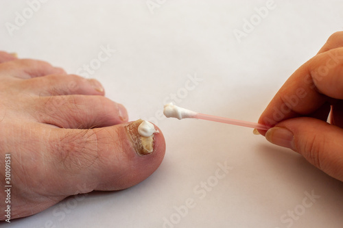 The female hand applies a cotton swab cream to the toenail affected by the fungus. A drop of cream on the toenail. White background. Copy space.