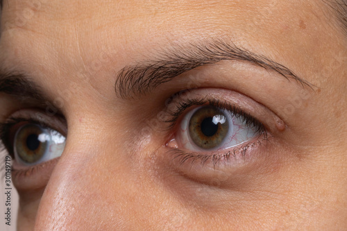 Quadro em tela Woman with eye capillaries and baggy skin close up side view
