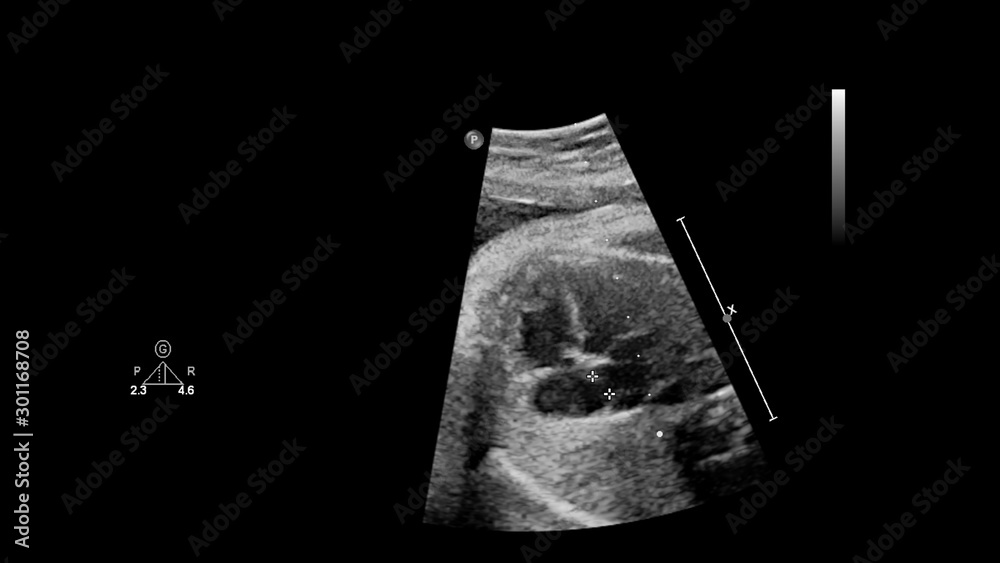 Ultrasound screen with fetal echocardiography. Ultrasound screen with fetal echocardiography.