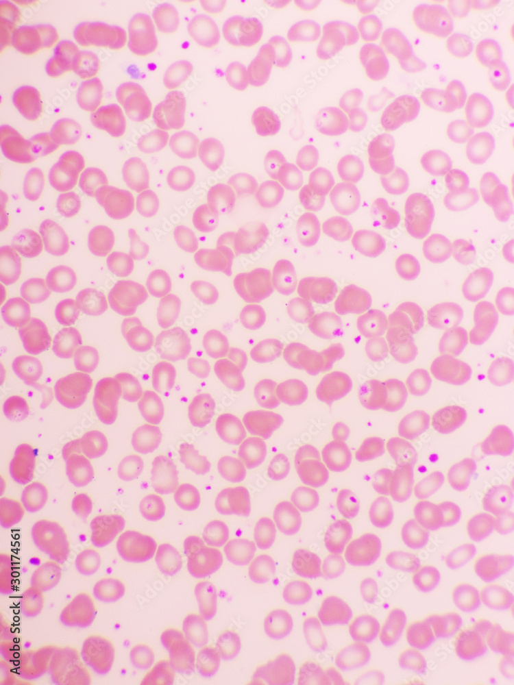 Essential thrombocytosis blood smear, present abnormal high platelet, analyze by microscope