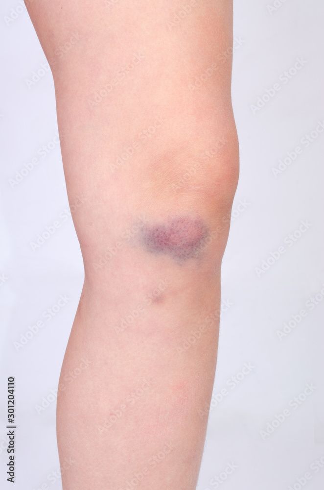 Bruise on a knee of a small child on a gray background Bruise on a knee of a small child on a gray background