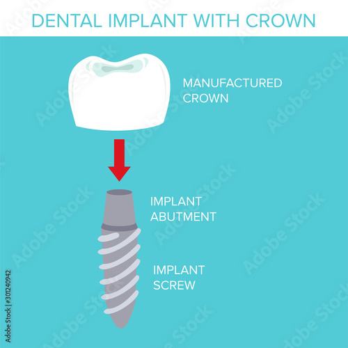 Illustration of a dental implant with crown