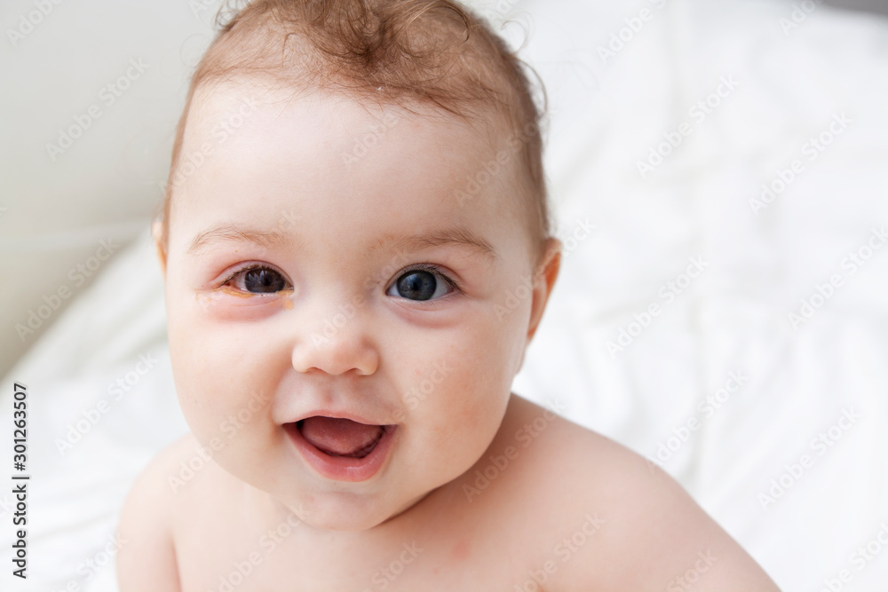 A little baby with soured eyes suffers from conjunctivitis A little baby with soured eyes suffers from conjunctivitis