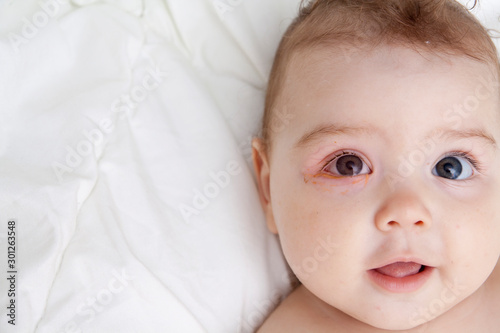 An infant with soured eyes suffers from conjunctivitis photo