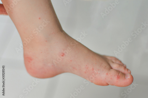 Enterovirus Leg arm mouth Rash on the body of a child Cocksackie virus photo