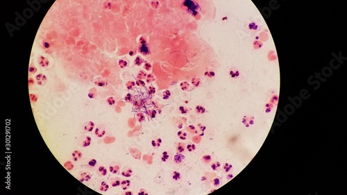 Nocardia organisms on Gram stain with white blood cells photo