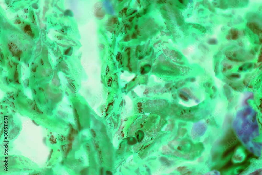 PC-3 human prostate cancer cells stained with blue Coomassie, under a differential interference contrast microscope. PC-3 human prostate cancer cells stained with blue Coomassie, under a differential interference contrast microscope.