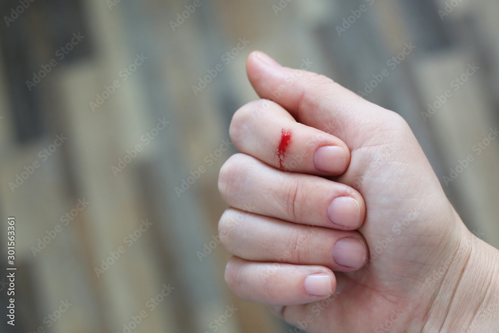 Finger with blood drop. Injured by sharp knife. Finger with blood drop. Injured by sharp knife.