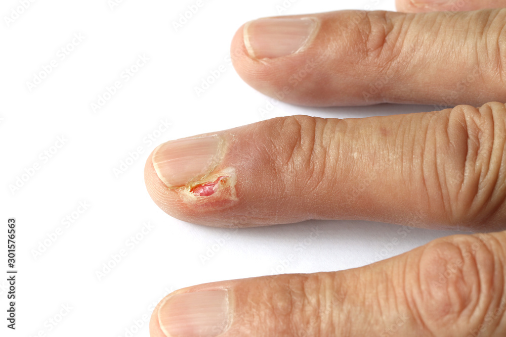 Lesion on finger isolated on white background Lesion on finger isolated on white background