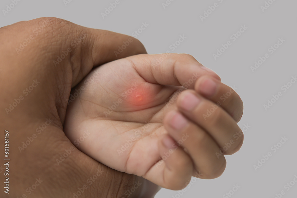 Close up  on arm young girl with skin problem, skin disease ,health care 