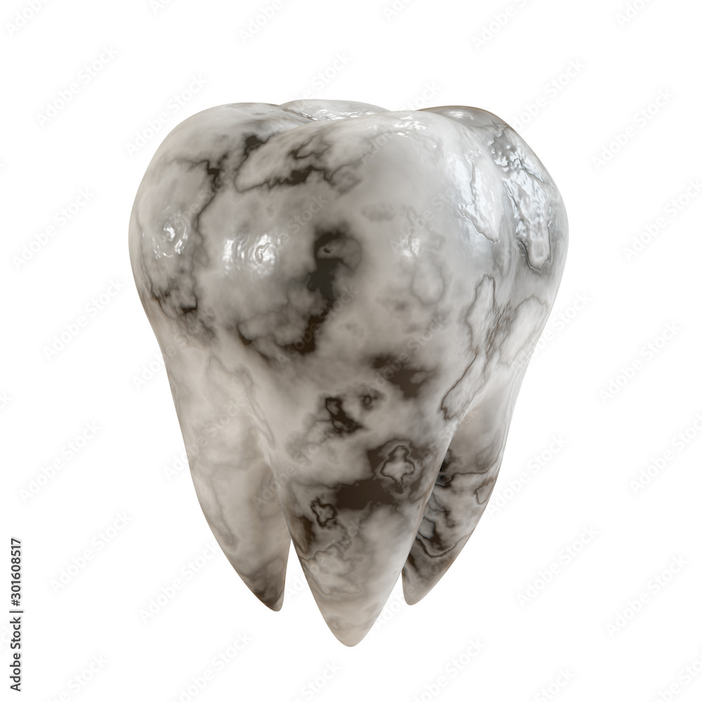 Caries patient tooth on a white background. Tooth disease. 3D Illustration. Caries patient tooth on a white background. Tooth disease. 3D Illustration.