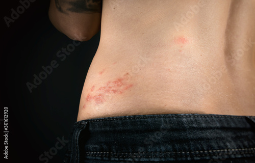 Shingles outbreak on torso of woman. The varicella-zoster virus has formed a red rash with fluid-filled blisters on the lower back (shingles belt) photo