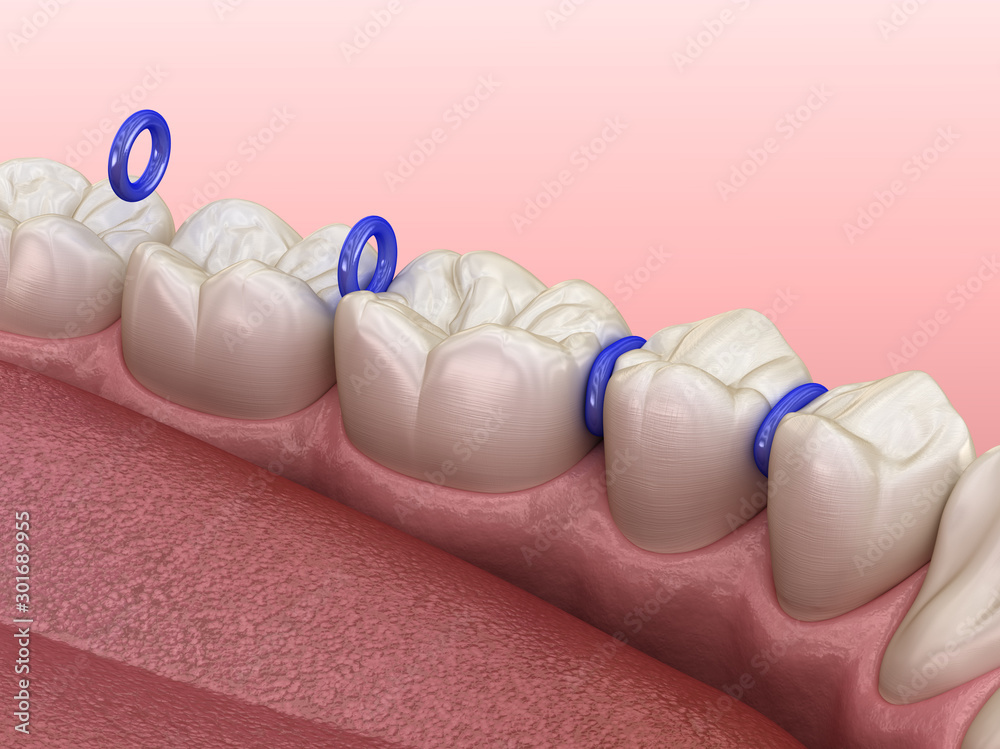 Rubber separator between teeth, preparation for braces placement