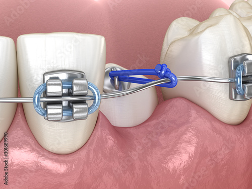 Impacted Cuspid and elastic for correction. Medically accurate dental 3D illustration