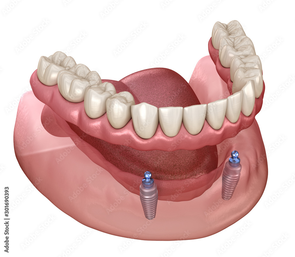 Mandibular removable prosthesis All on 2 system supported by implants