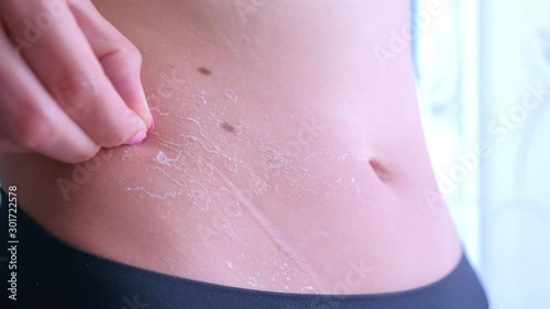 Woman flaking removing burnt skin on tummy after exposing too much to the sun. Woman is peeling skin from UV sunburn on stomach, closeup view.