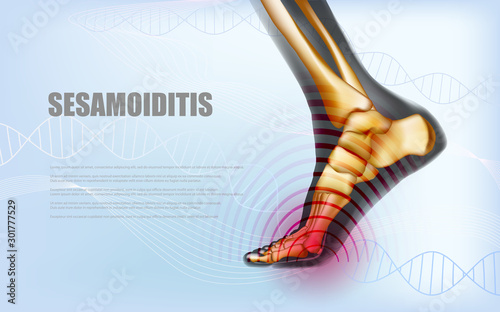 Horizontal sesamoiditis foot traumas banner