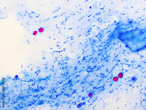 Cryptosporidium parvum protozoa positive (red sphere shape) in human stool smear, oocyst stage, acid-fast stain, analyze by microscope