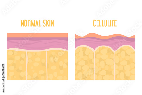 Cellulite skin and healthy skin anatomy. Fat tissue of human body