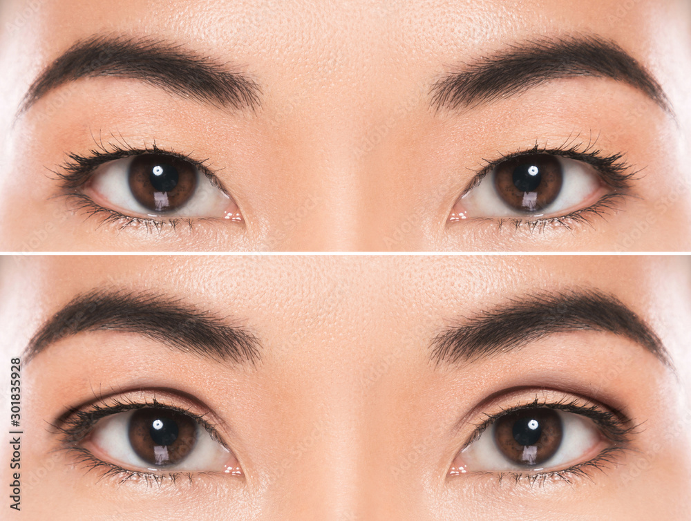 East Asian blepharoplasty or double eyelid surgery - obrazy, fototapety, plakaty 
