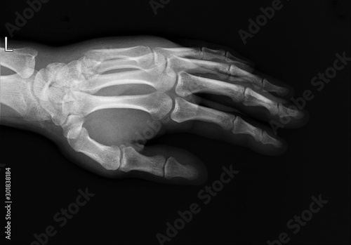 normal x-ray of the hand bones and fingers,orthopedics, medical diagnostics, rheumatology