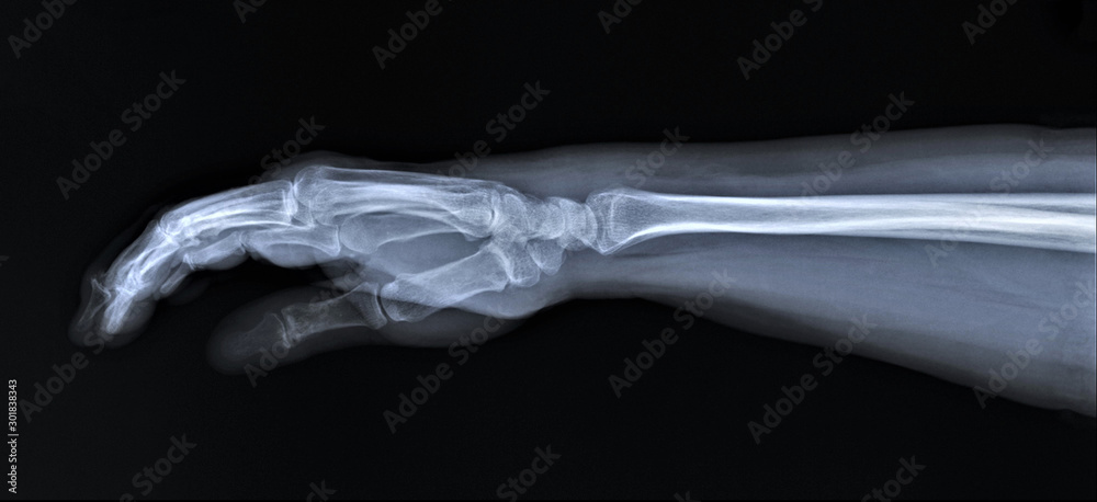 normal radiography of hand and wrist bones, traumatology and ...