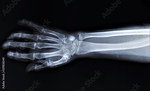 normal radiography of hand and wrist bones, traumatology and orthopedics, traumatology