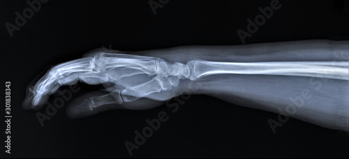 normal radiography of hand and wrist bones, traumatology and orthopedics, traumatology