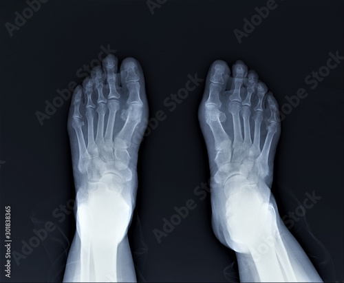 radiography of the foot by arthritis phenomena, medical diagnostics, Traumatology and orthopedics, rheumatology