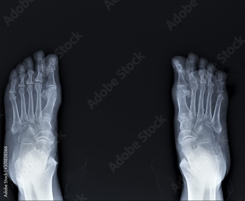 radiography of the foot by arthritis phenomena, medical diagnostics, Traumatology and orthopedics, rheumatology © Anton