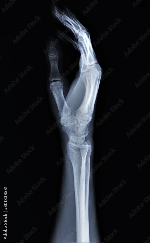 normal radiography of hand and wrist bones, traumatology and orthopedics, traumatology normal radiography of hand and wrist bones, traumatology and orthopedics, traumatology