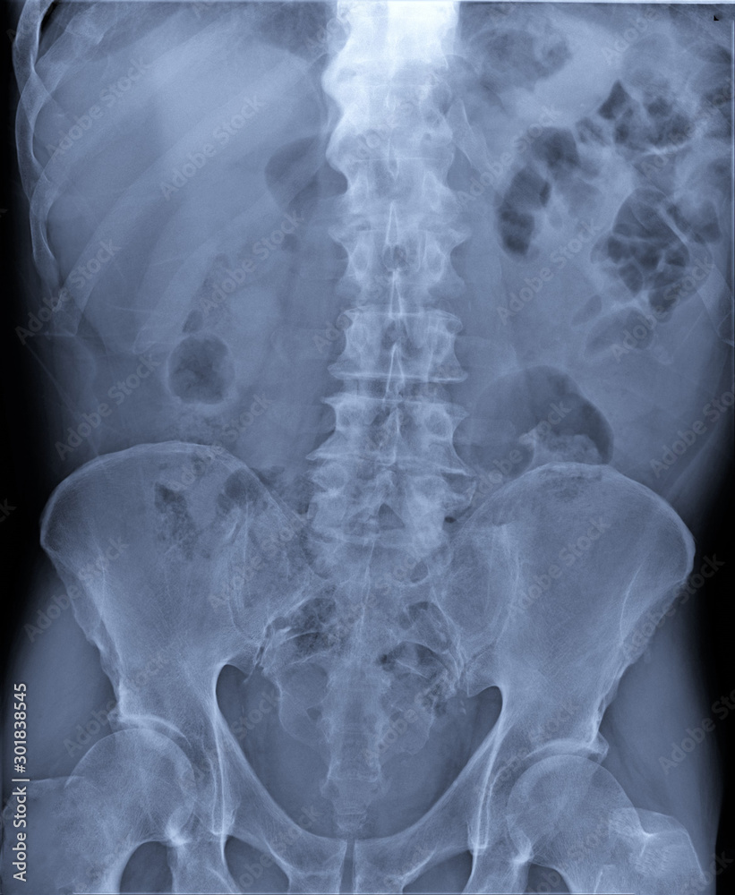 radiography of lumbar and sacral spine, pelvis, coxarthrosis, medical diagnostics radiography of lumbar and sacral spine, pelvis, coxarthrosis, medical diagnostics