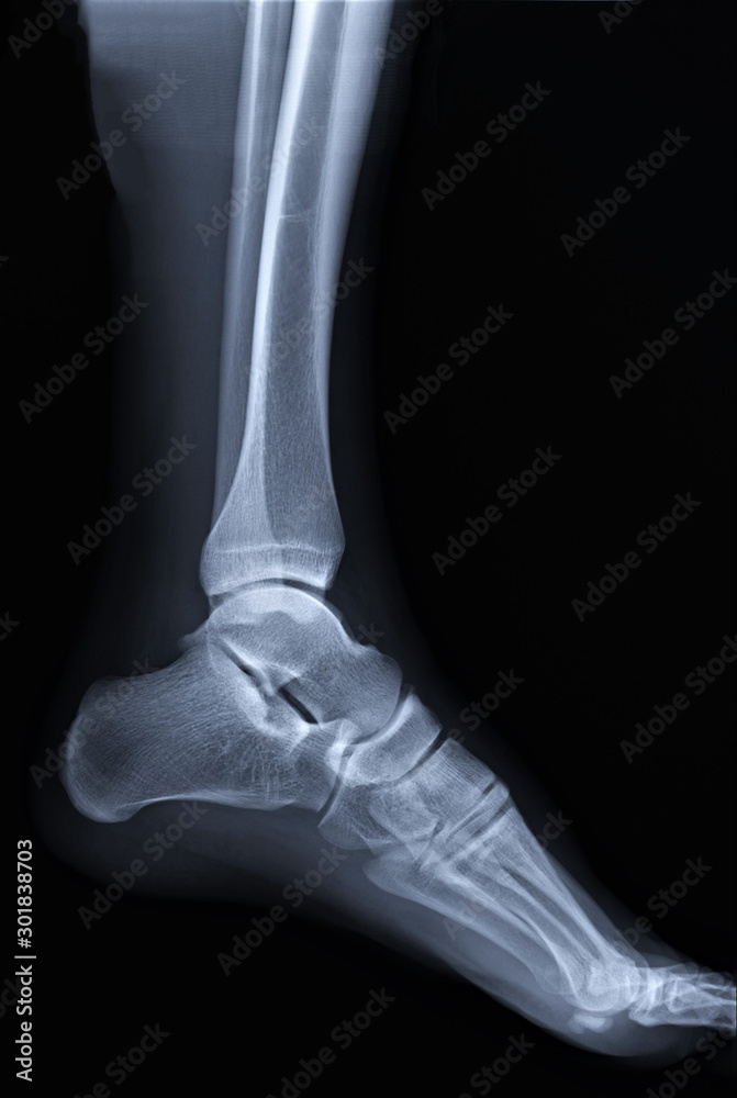 Naklejka premium normal radiography of the ankle joint in lateral projection, traumatology and orthopedics, rheumatology
