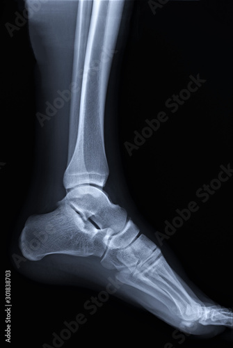 normal radiography of the ankle joint in lateral projection, traumatology and orthopedics, rheumatology