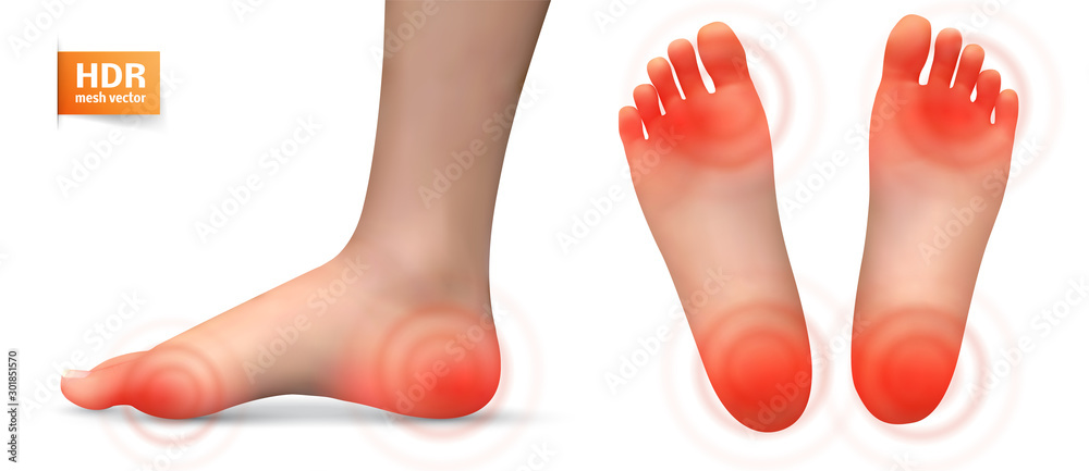 vector human foot.red spots of pain. ready element for medicine and orthopedics vector human foot.red spots of pain. ready element for medicine and orthopedics