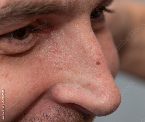 male elongated nose with pigmentation on the skin
