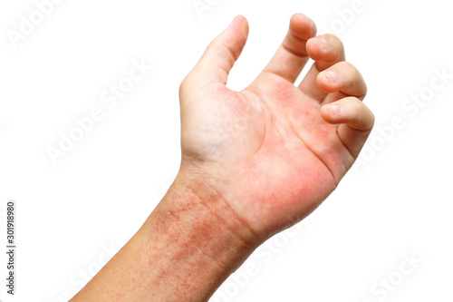 Red rash on wrist isolated on white background / Rashes on skin caused by virus