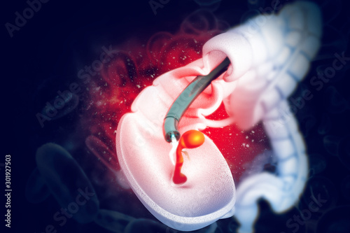 Foto colon cancer. colonoscope in the colon. polyp removal