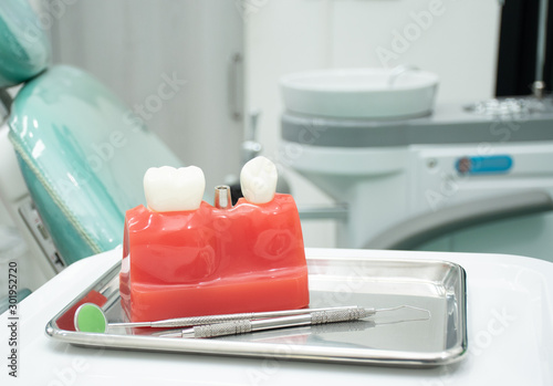 Examples of dental implants in the jawbone of the patient.