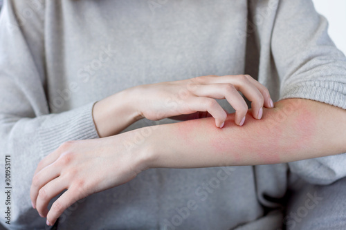 Closeup girl is scratching her hand with nails. Reddened, inflamed body parts causes discomfort and itching. Young woman is suffering from bouts of allergies. Dermatological skin diseases concept. photo
