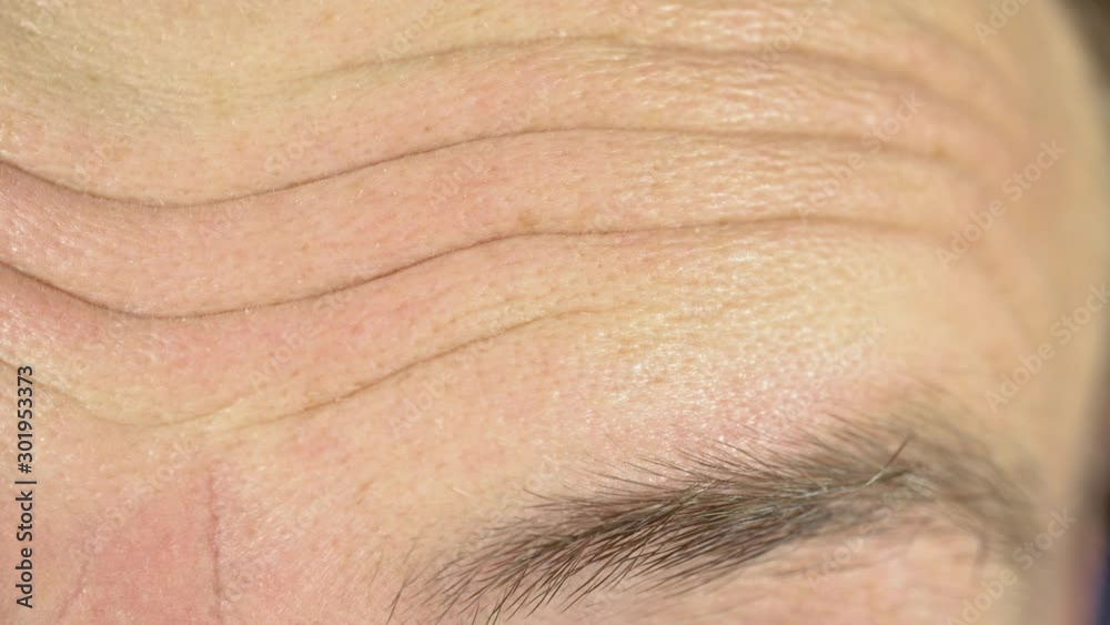 Facial wrinkles on the face of a person. Wrinkled forehead as a sign of surprise and bewilderment. A sign of age and aging close up. Manifestation of emotion.