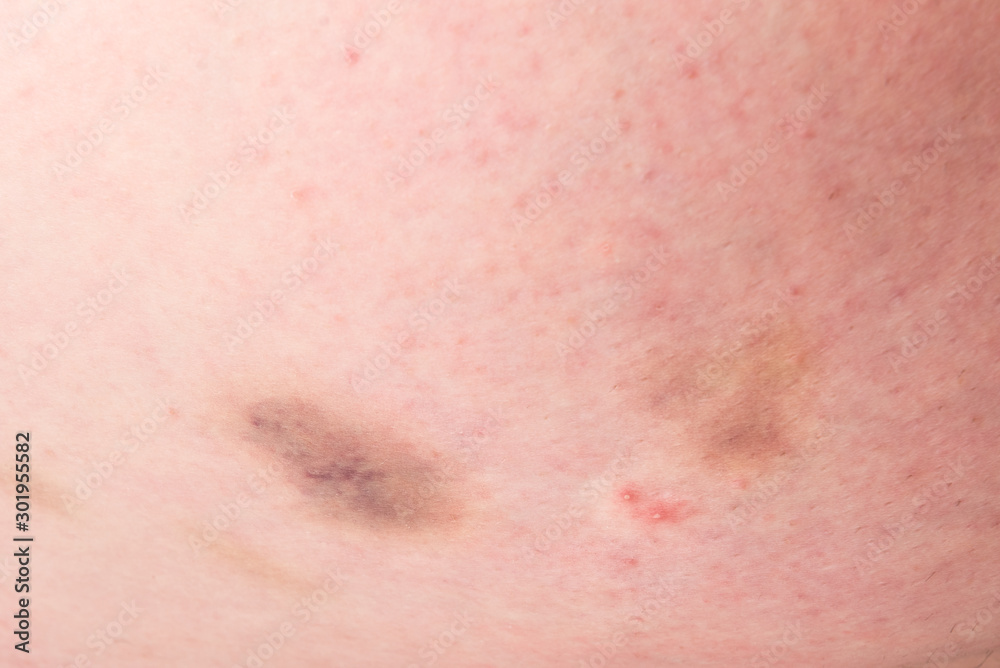 Hematoma or bruises on white skin