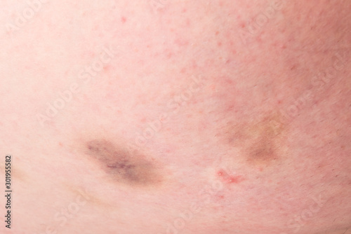 Hematoma or bruises on white skin