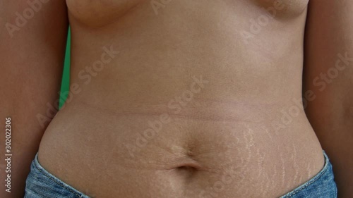 Caucausian woman with stretch marks on her belly, static shot of mid-section