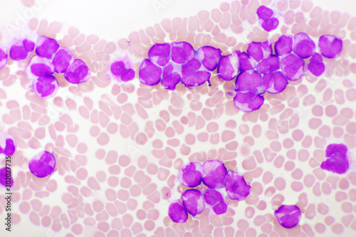Acute promyelocytic leukemia cells or APL, analyze by microscope, original magnification 1000x photo