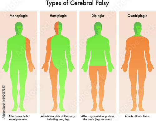 Forms of Cerebral Palsy illustrated in medical diagram.