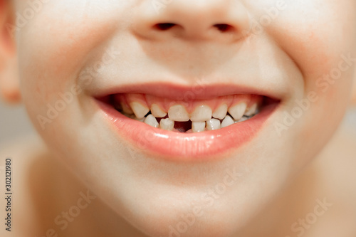 happy 6 year old boy shows teeth. loss of children s teeth.