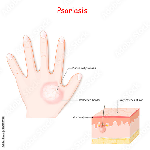 psoriasis of human hand. Symptoms of disease
