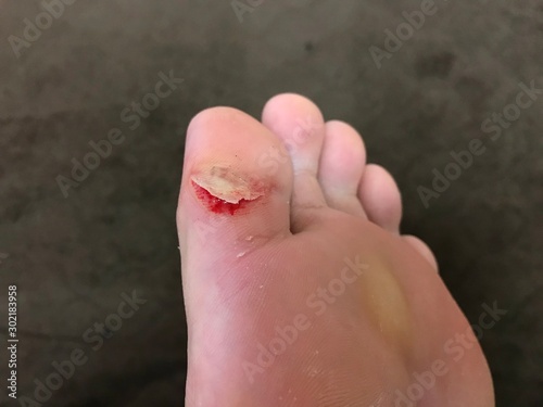 Foto 足の親指を負傷した女性
